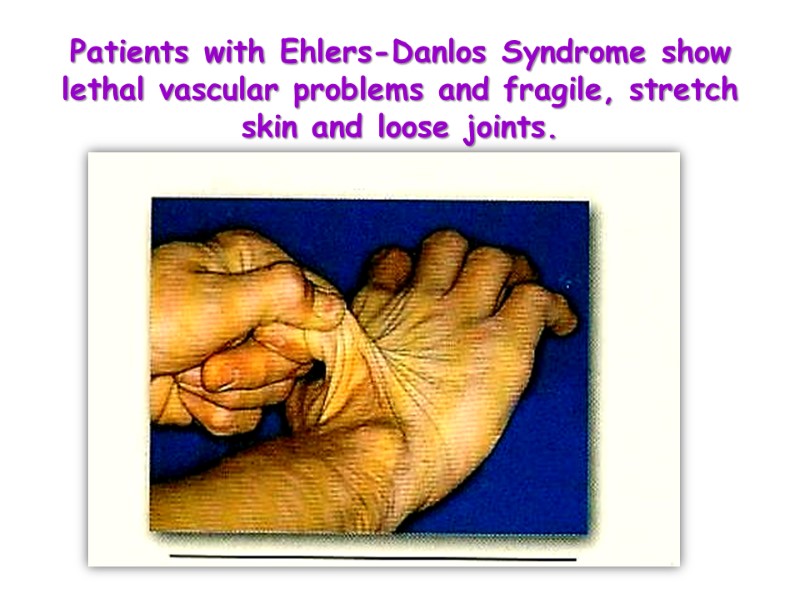 Patients with Ehlers-Danlos Syndrome show lethal vascular problems and fragile, stretch skin and loose